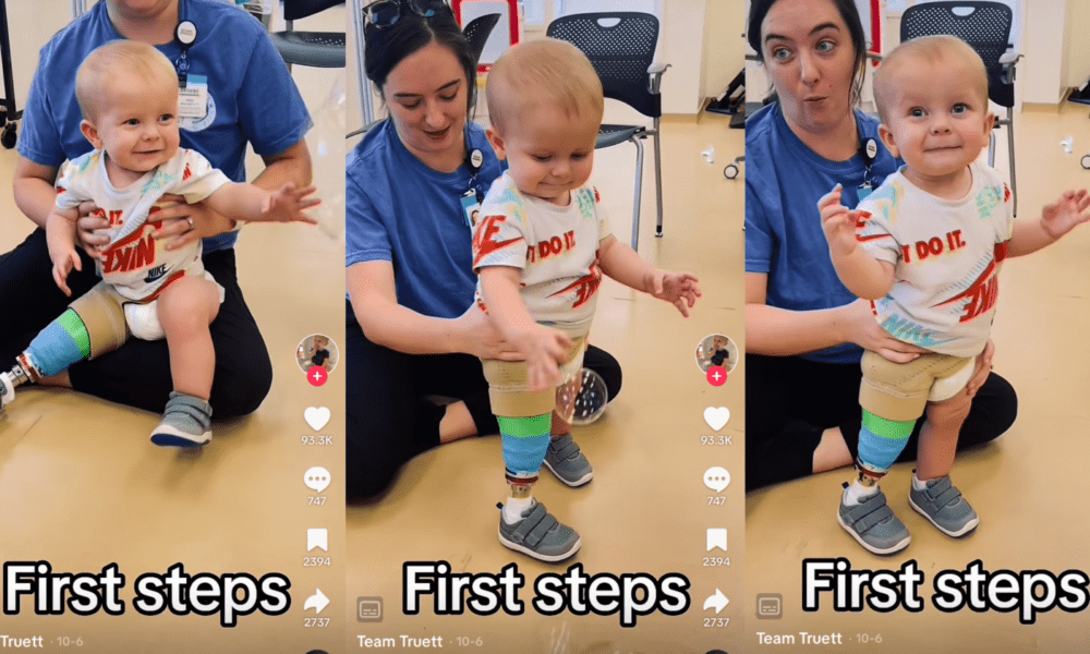 Heart-Warming Moment: Baby Takes First Steps with Prosthetic Leg Following Birth Defect