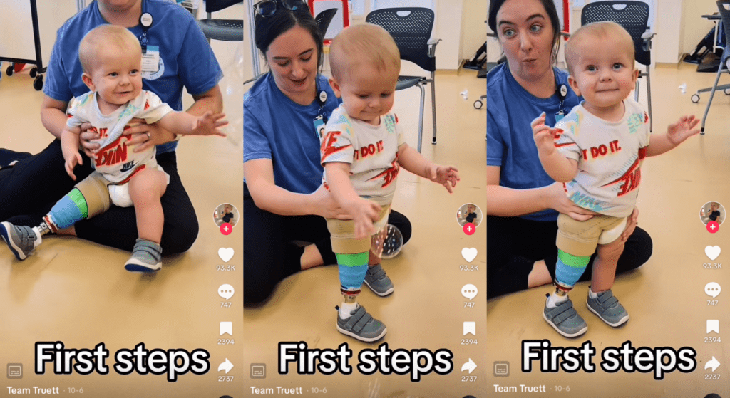 Inspirational Journey: Baby's First Steps with Prosthetic Leg After Overcoming Severe Birth Defect